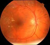 Treatment of macular edema with laser only This 60 year