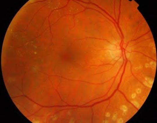 diabetic macular edema in both eyes.vision was 6/6, N6.
