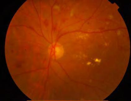 with poor , fundus