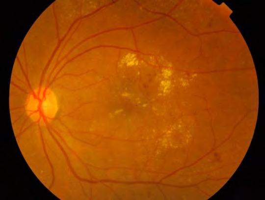 4. Resolution of macular edema with laser and metabolic control This 40 year old