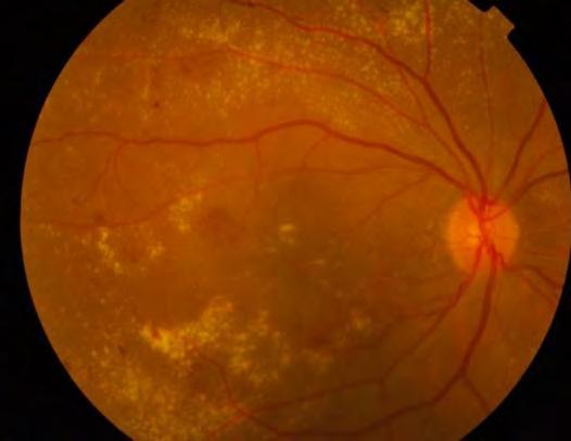 macular edema on 03-08-07. Her vision was 6/18, N10 in both eyes.