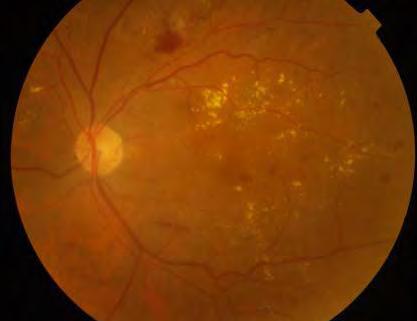 8.Resolution of macular edema with laser and