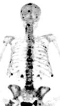 99mTc MDP bone scan vs 18FNaF PET