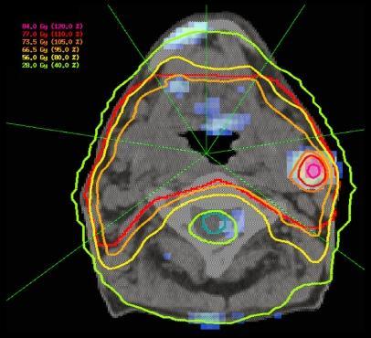F-MISO in radiotherapy The 18FDG-PET image: Increased uptake in