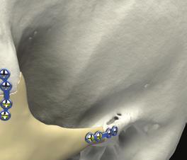 Craniofacial reconstruction and repair of the craniofacial skeleton Implants