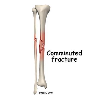 Bone Injuries Comminuted Fracture 3 or more fragments of bone