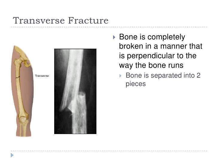 Bone Injuries