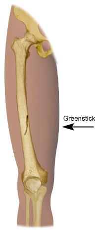 Bone Injuries Greenstick (Fissure) Fracture The bone bends much like a green tree branch.