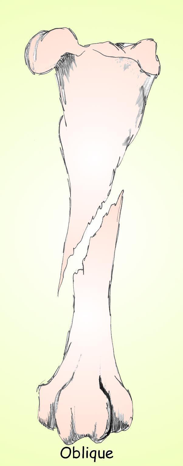 Bone Injuries Oblique Fracture Twisting injury Twisting on end of the bone while the other end is stabilized Longitudinal and oblique fractures usually