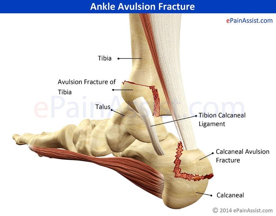 Avulsion Injury to the bone in which part of the bone is pulled off by an attaching tissue.