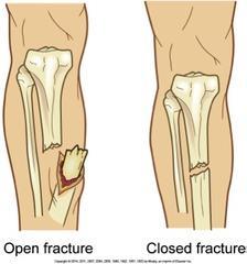 Open vs. Closed Fracture Closed Fracture- the bone is broken but the bone ends do not pierce through the skin Open Fracture- most serious type of fracture, the bone ends pierce through the skin.