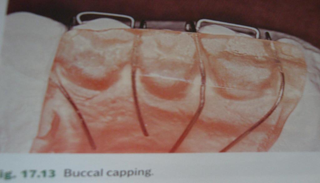 Baseplate Self -cure or heat-cure acrylic Anterior bite-plane (increasing the thickness of acrylic behind the upper incisors) Buccal capping (it is useful