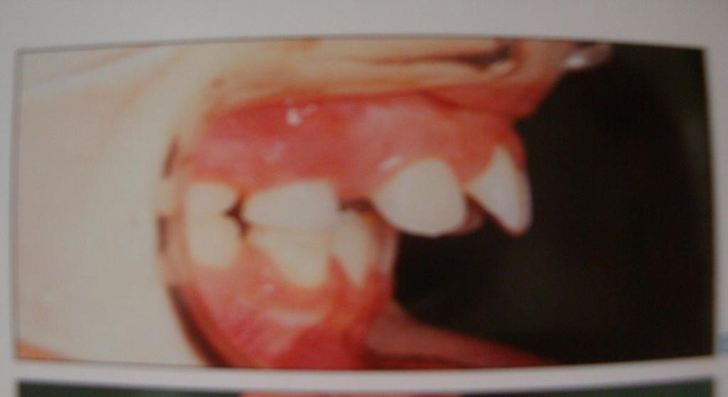 at the mandibular teeth