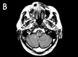 Journal of Clinical Neurology: Vol. 2, No. 2, 2006 Figure 1. Case 1: A 69-year-old male patient with acute lateral medullary infarction.
