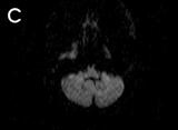 (C, D) At 63 h after onset of symptoms, the follow-up DWI and FLAIR imaging show a clear hyperintensity in the right lateral medullar area, matching the clinical presentation.