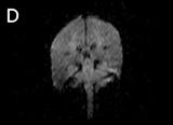 (B) At 96 h after onset of symptoms, FLAIR imaging shows hyperintensity in the right lateral medullar area, matching the clinical presentation.
