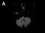 Time-to-MRI, lesion size and the number of symptoms and signs of 26 patients with lateral medullary infarction Initial DWI findings (n) Time-to-MRI (hr) Lesion size (cm 3 )