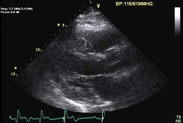 More Typical Scenario: Myocardial Rupture 65 year old male Inf Lat MI, PCI with DES, EF 45% Two