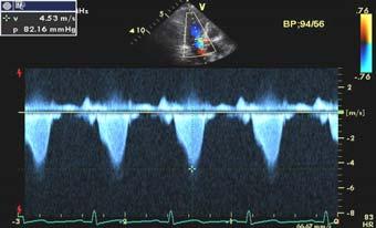 acute anterior myocardial infarction: serial echocardiographic and