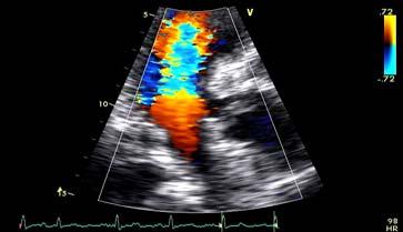 Dynamic left ventricular outflow tract obstruction as a Hyperkinetic
