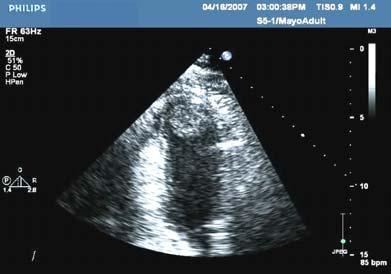 detected myocardial in 15 patientsinfarction during the first treated 3 months, 2/3 of them within the first week acutely