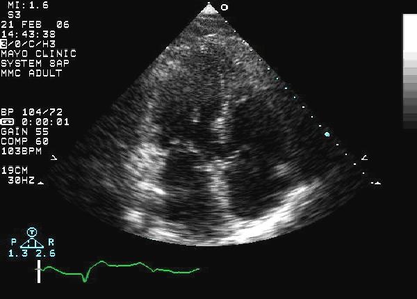 Partial Papillary Muscle Rupture: Chaotic Motion of Subvalvular Apparatus LV RV Partial Papillary