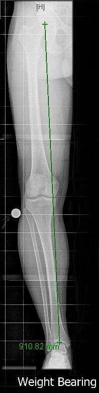 X-ray of knee before