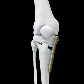 osteotomy with plate and