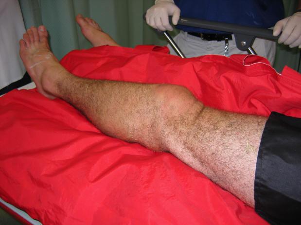 Dislocation of the Knee Dislocation Serious ligamentous and soft tissue damage. Assess above and below knee.