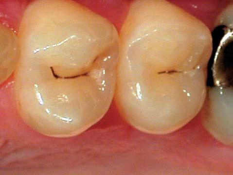 At baseline the DIAGNOdent readings had been 27 in the first premolar and 24 in the second premolar.
