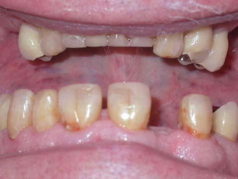 toothpastes, mouthrinses and sprays. In this case this Patient had also been given the HealOzone toothpaste, mouthrinse and spray to use, incommon with the Patient in figure 19.