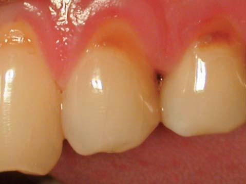 Figure 24: This photograph is the recall appearance of these 2 molar teeth.