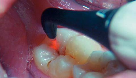 lesion mre predictably. Figure 30: DIAGNOdent readings are recorded after the PROPHYflex cleaning. 1. Abu-Naba,a Management of Primary Occlusal Pit and Fissure Caries Using Ozone.