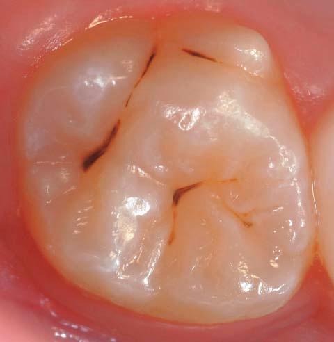 caries free for a longer period of time. Ozone has been proposed as a promising tool to achieve this end.