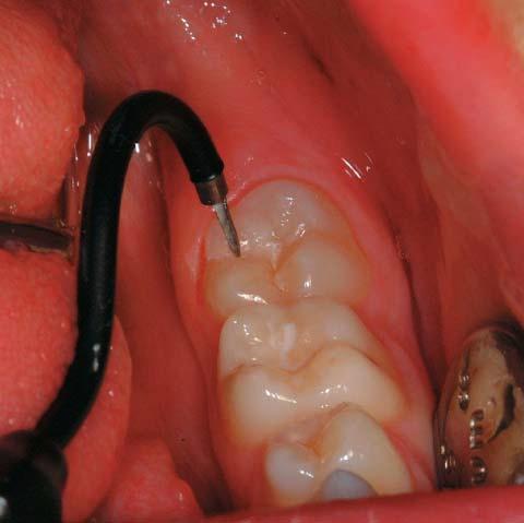 Patients were admitted to the study with 2 contra-lateral permanent molars showing non-cavitated occlusal