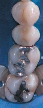 To maintain as much tooth structure as possible it was decided to apply Ozone after
