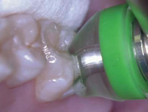 Case number 2 Figure 2-3: Occlusal view of the finished restorations. Figure 2-1: Preoperative occluso buccal view.