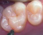 Case number 4 This 22-year-old young lady had sealants placed 8 years ago.