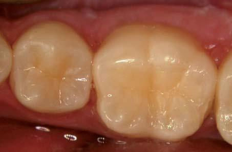 A non invasive decay removal protocol was applied to this tooth.