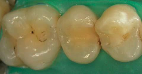 Case number 6 Figure 6-4: Occlusal view of the completed restorations.