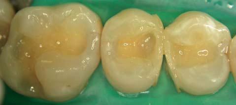 Figure 6-2: Clinical situation after caries removal.