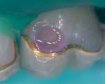 After superficial excavation Caries