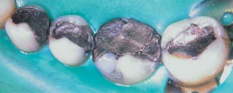 removal of the insufficient restorations.
