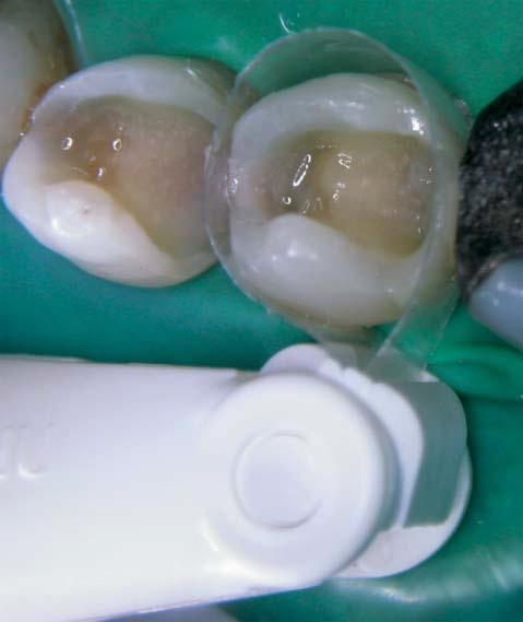 It is always easier to build up the occlusal relief of a class I  For