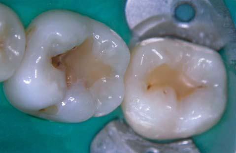 Figure 10-1: Occlusal picture featuring the delaminated and discoloured restoration