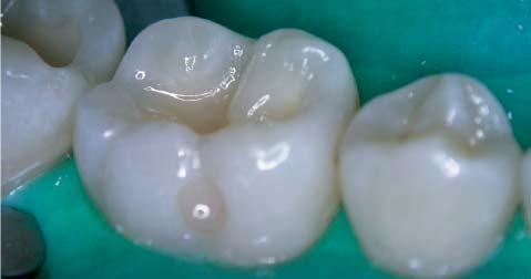 The dentine wall is covered with a layer of flowable (Flow It ALC, Pentron) and light cured.