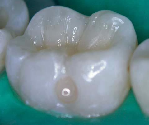 The second molar is restored following the same criteria.