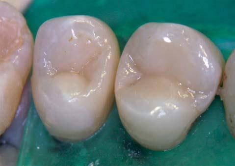 Figure 10-15 The occlusal check up indicated a very