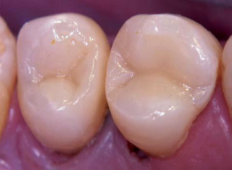 Figure 11-2: Both premolars restored with direct composite
