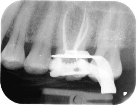 the performed root canal obturation.